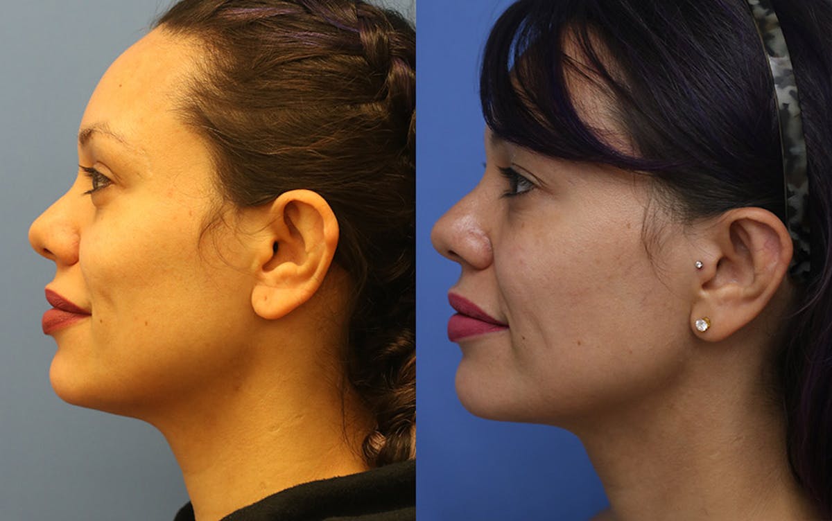 Otoplasty Before & After Gallery - Patient 115575 - Image 3