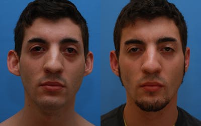Otoplasty Before & After Gallery - Patient 387323 - Image 1