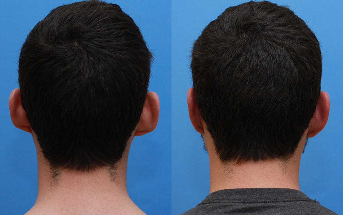 Otoplasty Before & After Gallery - Patient 387323 - Image 2