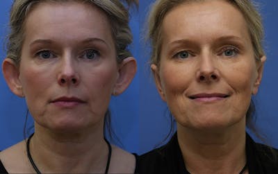 Otoplasty Before & After Gallery - Patient 226674 - Image 1