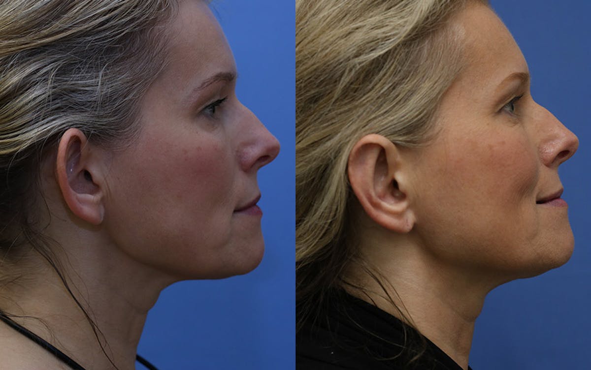 Otoplasty Before & After Gallery - Patient 226674 - Image 2