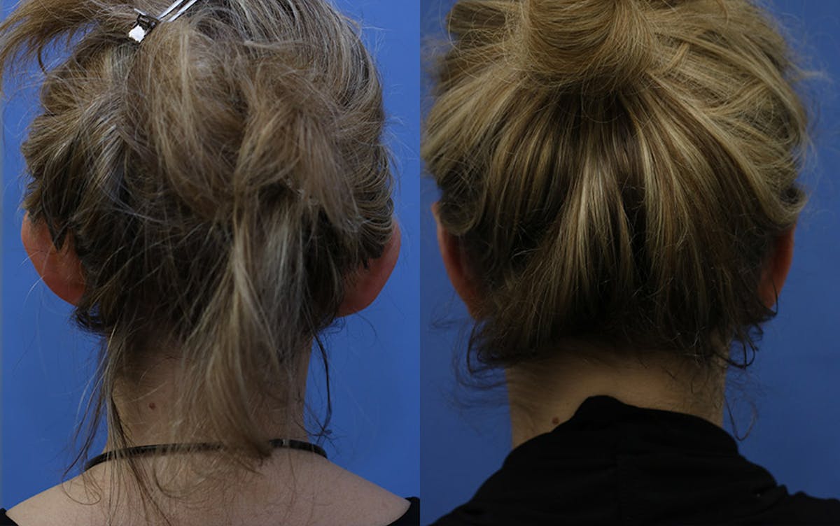 Otoplasty Before & After Gallery - Patient 226674 - Image 3