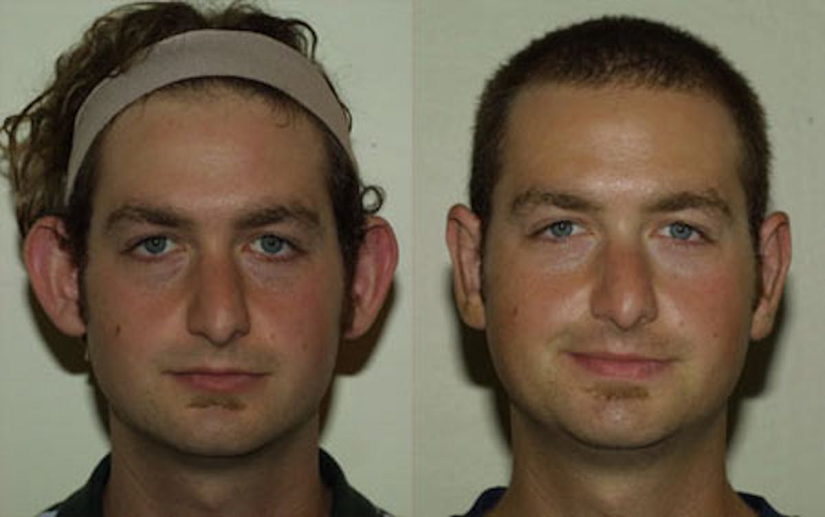 Otoplasty Before & After Gallery - Patient 117354 - Image 1