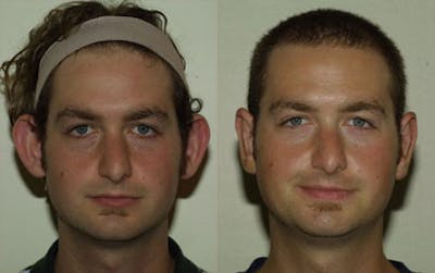 Otoplasty Before & After Gallery - Patient 117354 - Image 1