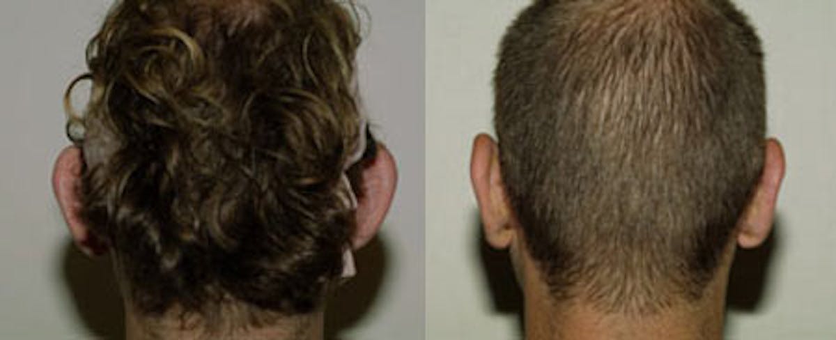 Otoplasty Before & After Gallery - Patient 117354 - Image 2