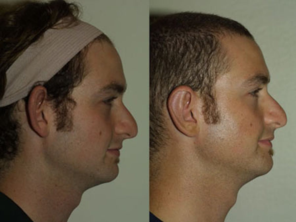 Otoplasty Before & After Gallery - Patient 117354 - Image 3