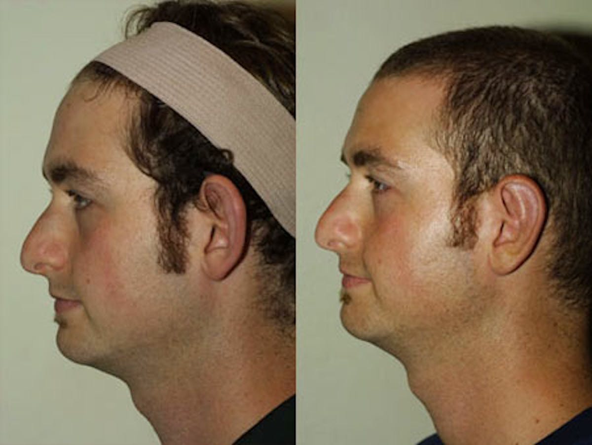 Otoplasty Before & After Gallery - Patient 117354 - Image 4