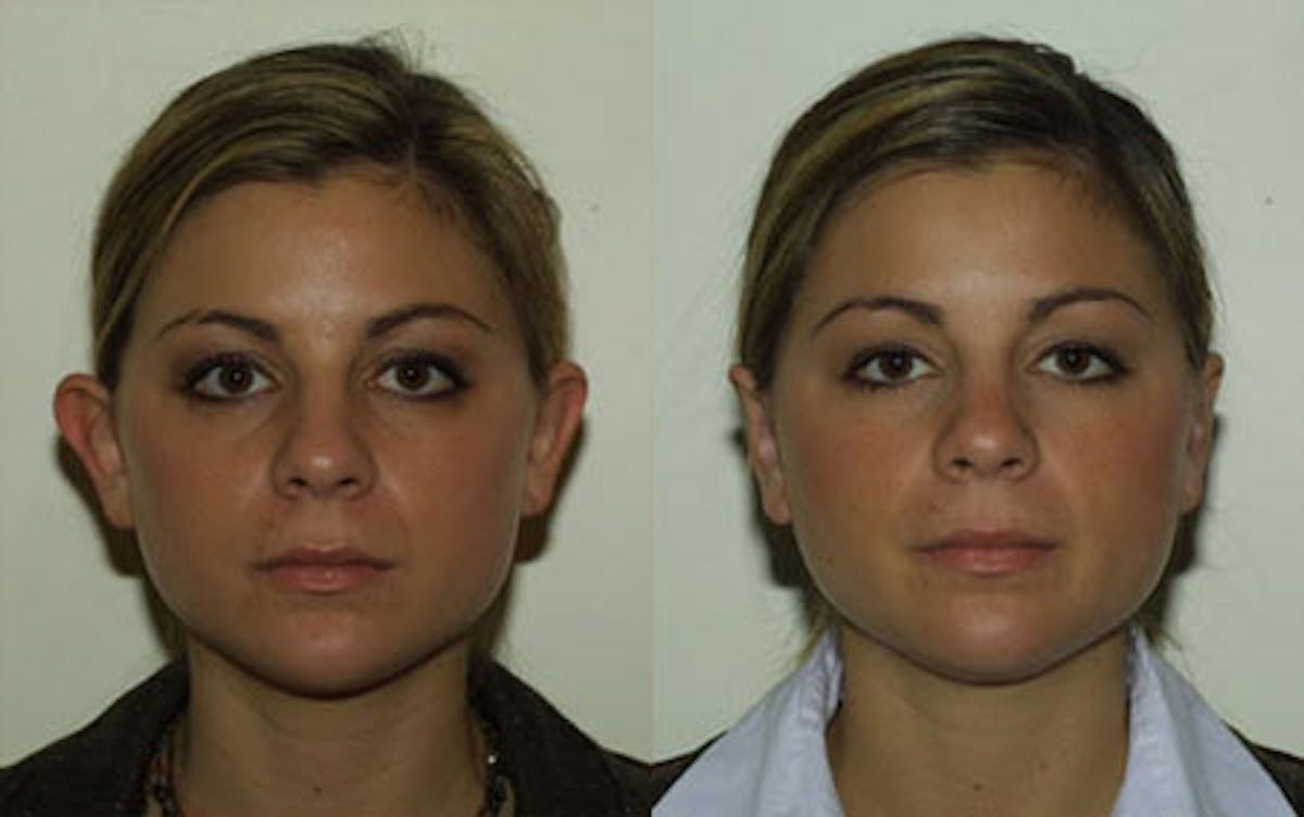Otoplasty Before & After Gallery - Patient 320504 - Image 1