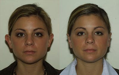 Otoplasty Before & After Gallery - Patient 320504 - Image 1