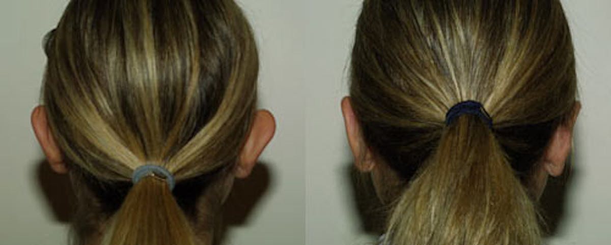 Otoplasty Before & After Gallery - Patient 320504 - Image 2