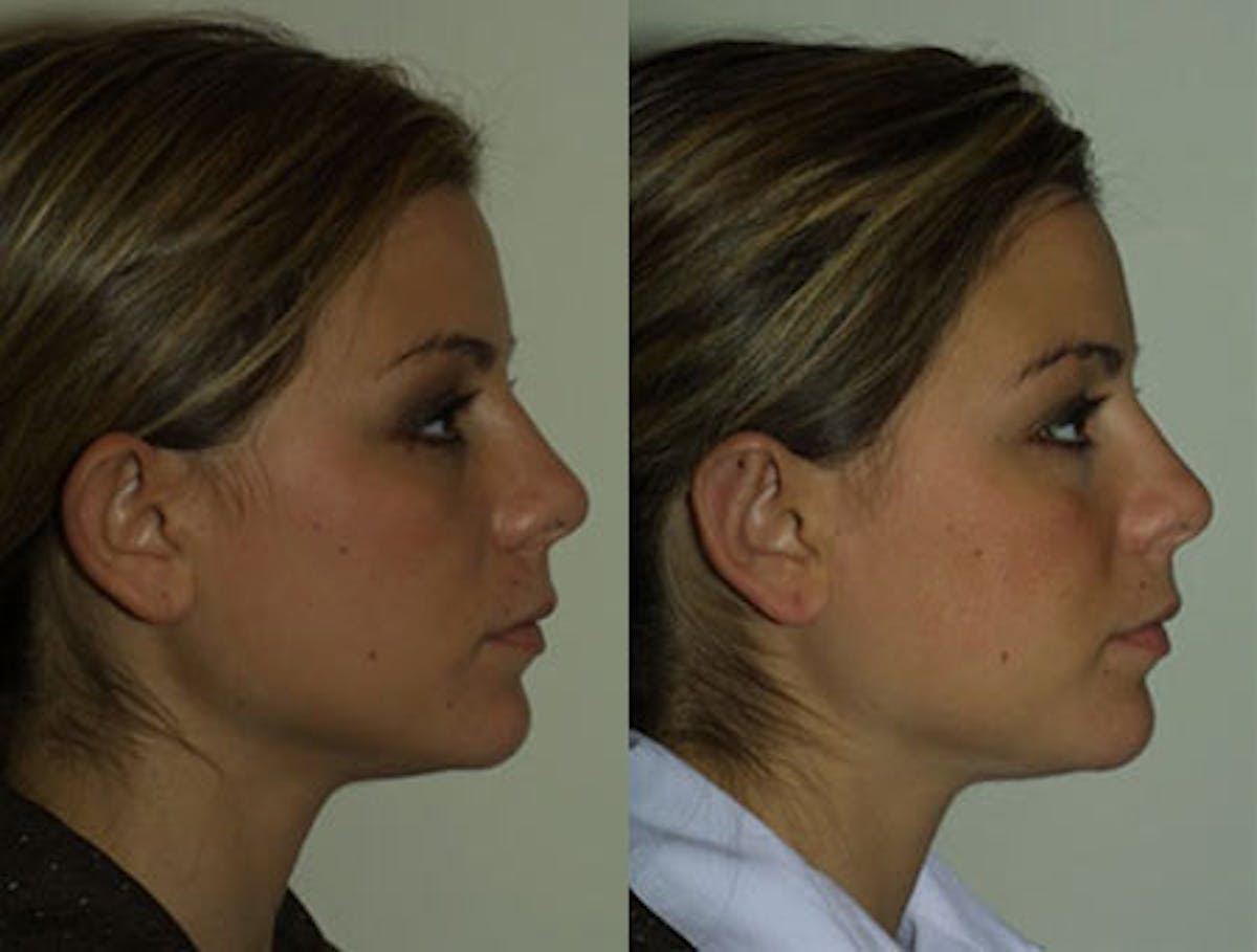 Otoplasty Before & After Gallery - Patient 320504 - Image 3