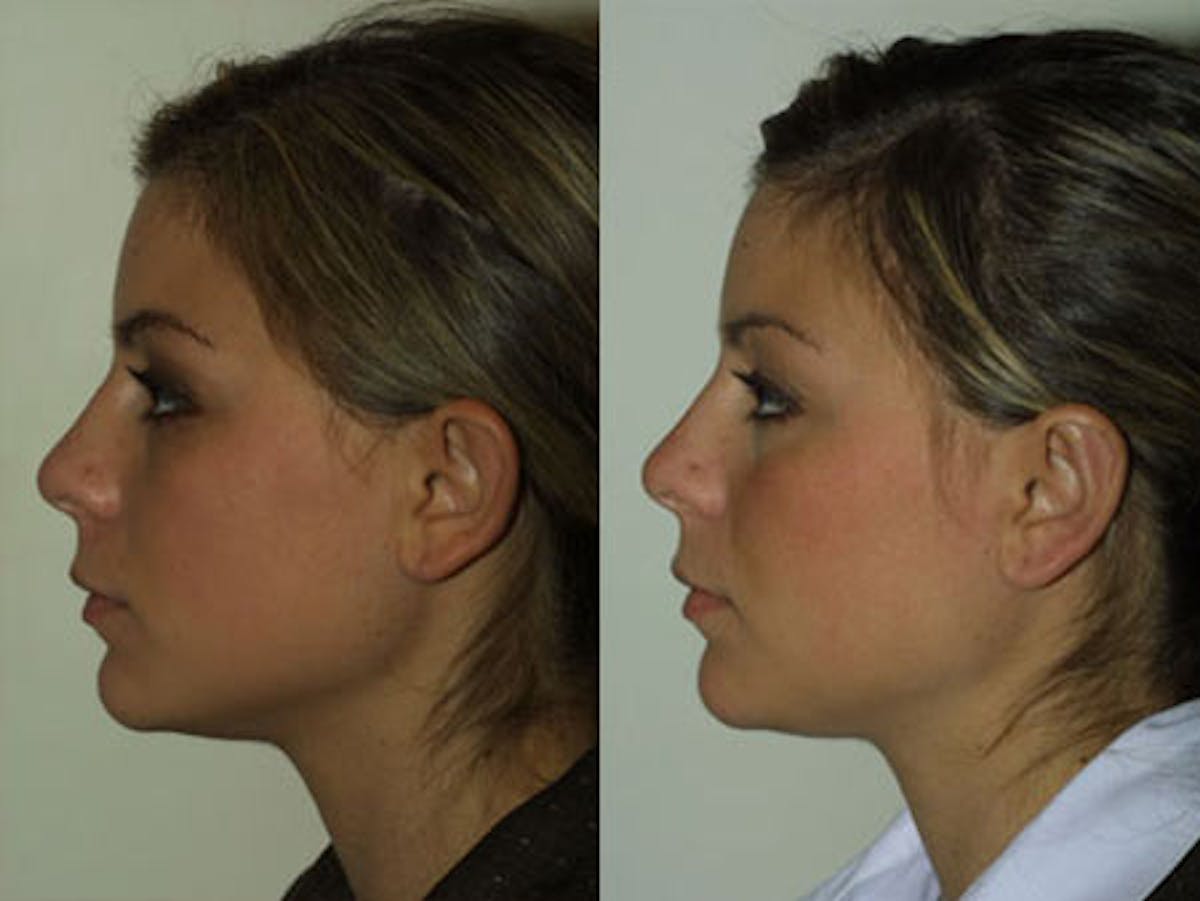 Otoplasty Before & After Gallery - Patient 320504 - Image 4
