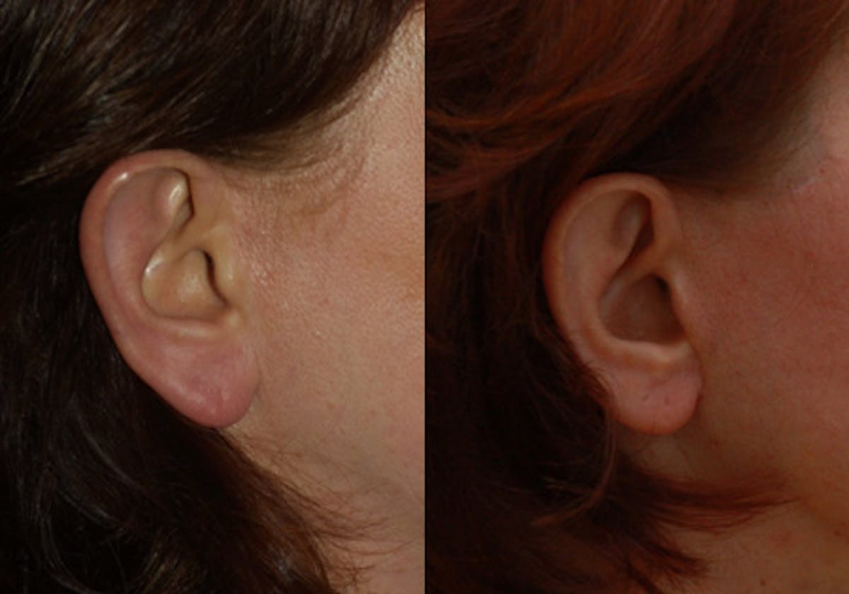Otoplasty Before & After Gallery - Patient 104130 - Image 1