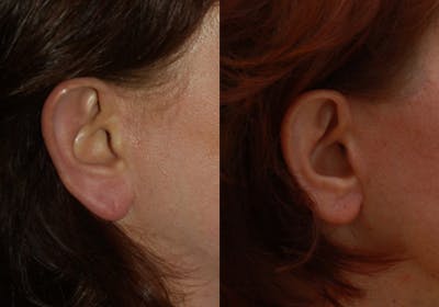 Otoplasty Before & After Gallery - Patient 104130 - Image 1