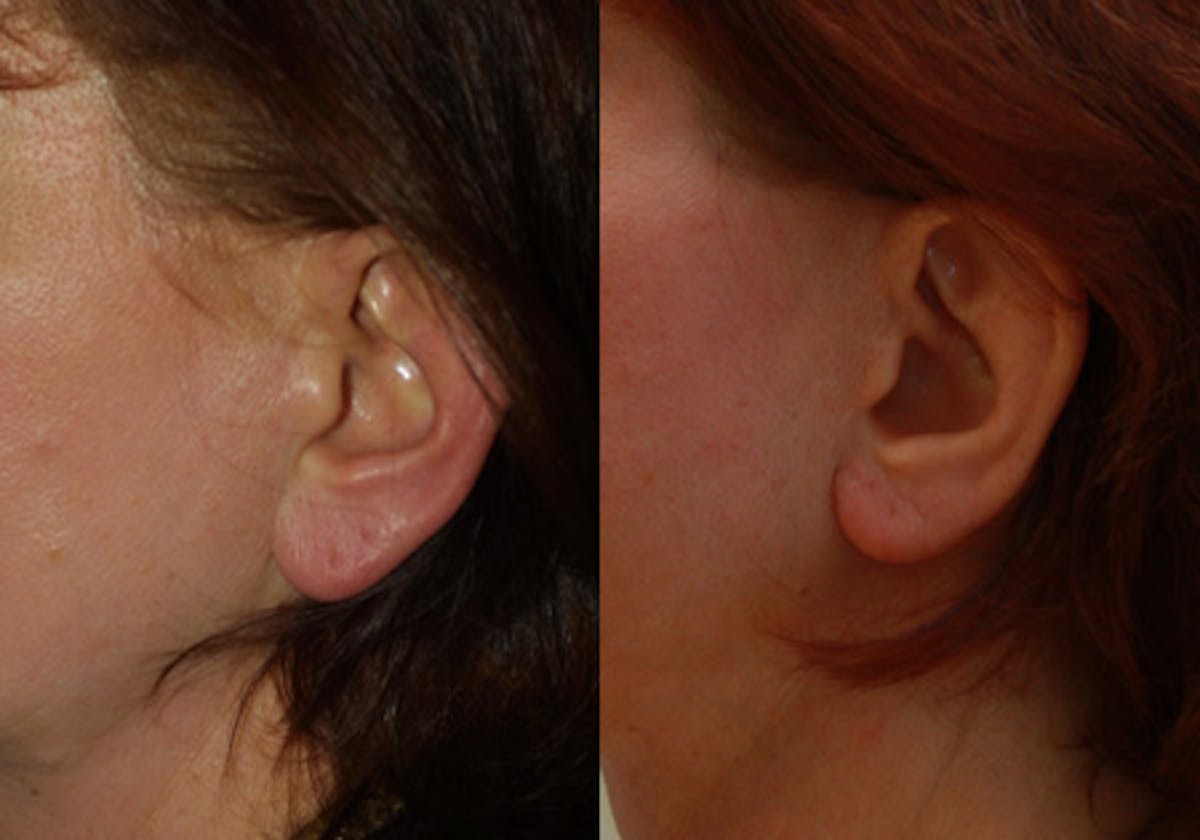 Otoplasty Before & After Gallery - Patient 104130 - Image 2