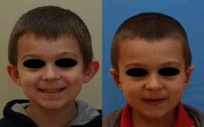 Otoplasty Before & After Gallery - Patient 281995 - Image 1