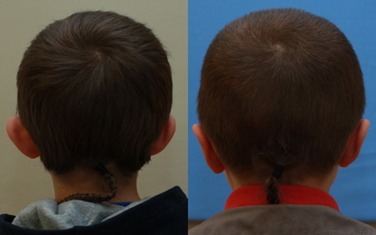 Otoplasty Before & After Gallery - Patient 281995 - Image 2