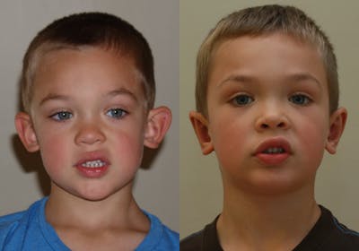 Otoplasty Before & After Gallery - Patient 236871 - Image 1