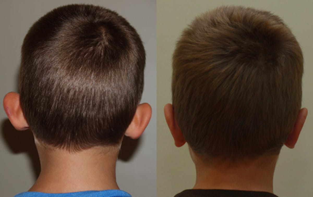 Otoplasty Before & After Gallery - Patient 236871 - Image 2