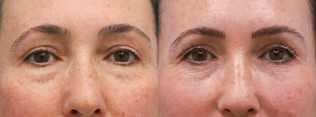 Eyelids Before & After Gallery - Patient 225788 - Image 1