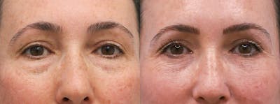 Eyelids Before & After Gallery - Patient 225788 - Image 1