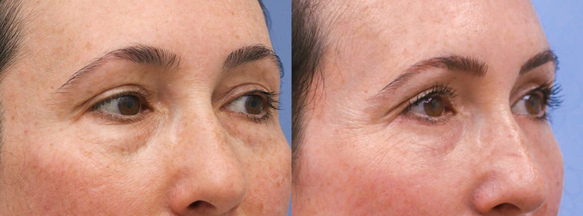 Eyelids Before & After Gallery - Patient 225788 - Image 2