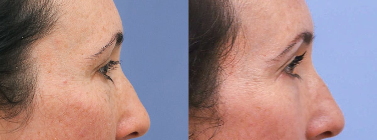 Eyelids Before & After Gallery - Patient 225788 - Image 3