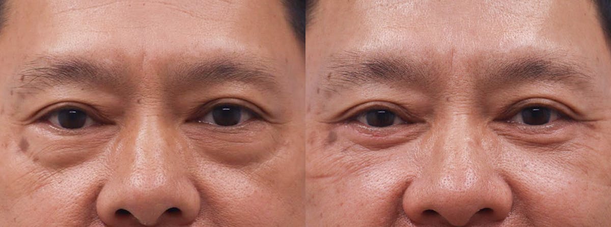 Eyelids Before & After Gallery - Patient 238141 - Image 1