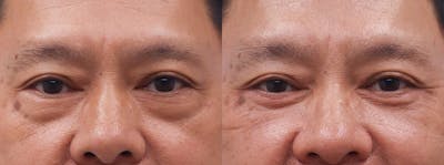 Eyelids Before & After Gallery - Patient 238141 - Image 1