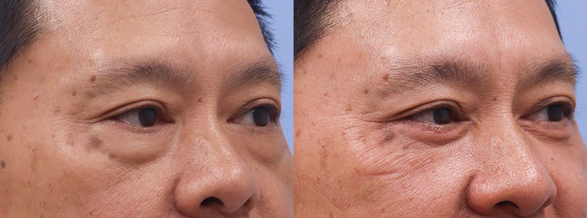Eyelids Before & After Gallery - Patient 238141 - Image 2