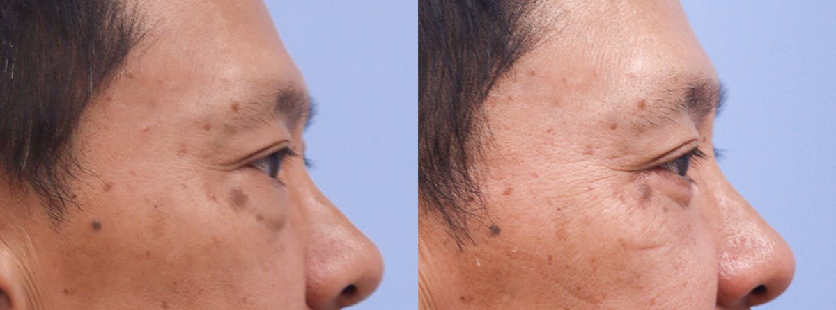Eyelids Before & After Gallery - Patient 238141 - Image 3