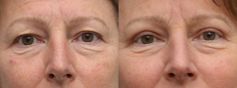 Eyelids Before & After Gallery - Patient 298791 - Image 1