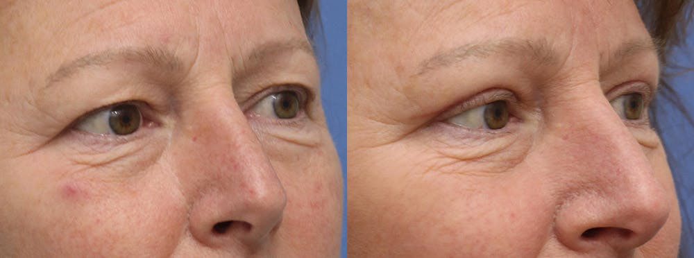 Eyelids Before & After Gallery - Patient 298791 - Image 2