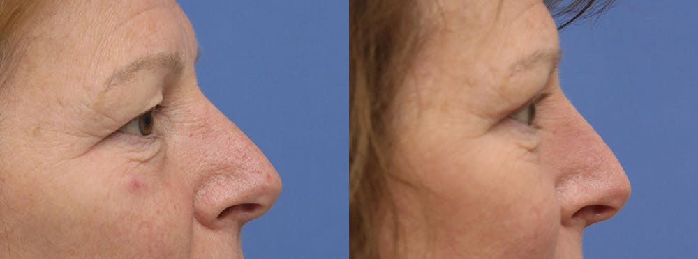 Eyelids Before & After Gallery - Patient 298791 - Image 3