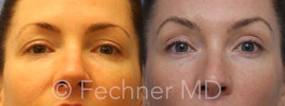 Eyelids Before & After Gallery - Patient 596516 - Image 1