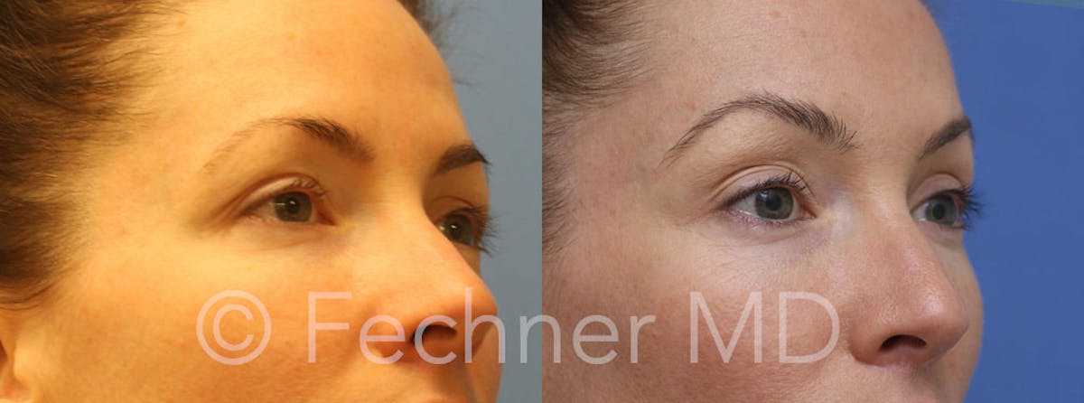 Eyelids Before & After Gallery - Patient 596516 - Image 2