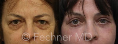 Eyelids Before & After Gallery - Patient 193396 - Image 1