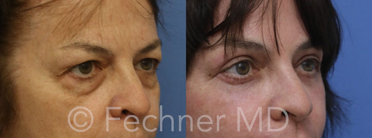 Eyelids Before & After Gallery - Patient 193396 - Image 2