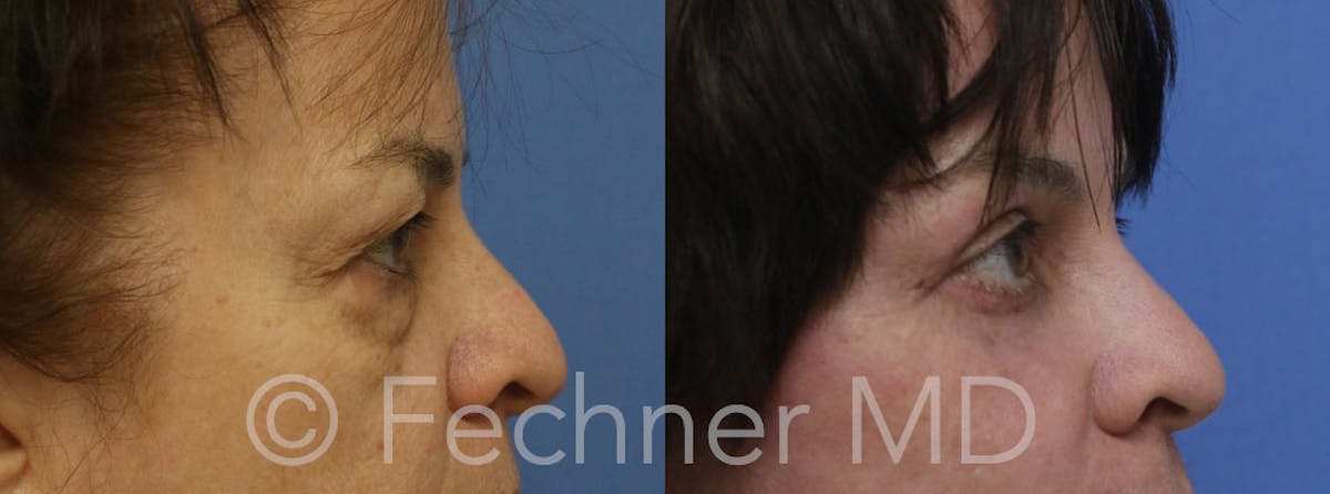 Eyelids Before & After Gallery - Patient 193396 - Image 3