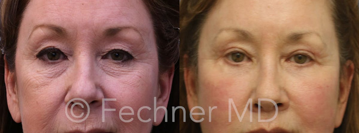 Eyelids Before & After Gallery - Patient 414280 - Image 1