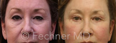 Eyelids Before & After Gallery - Patient 414280 - Image 1