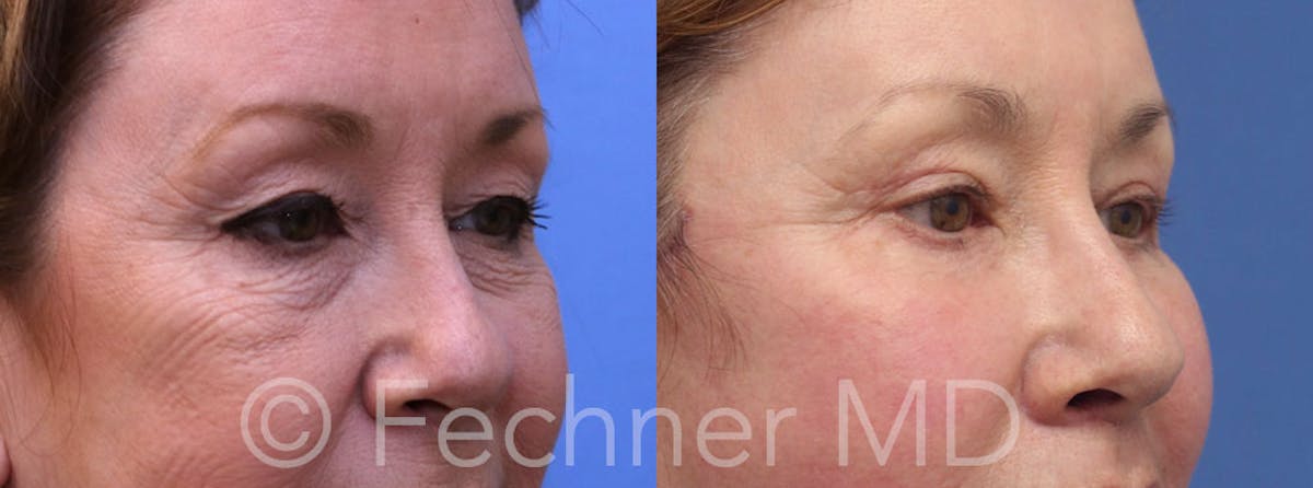 Eyelids Before & After Gallery - Patient 414280 - Image 2