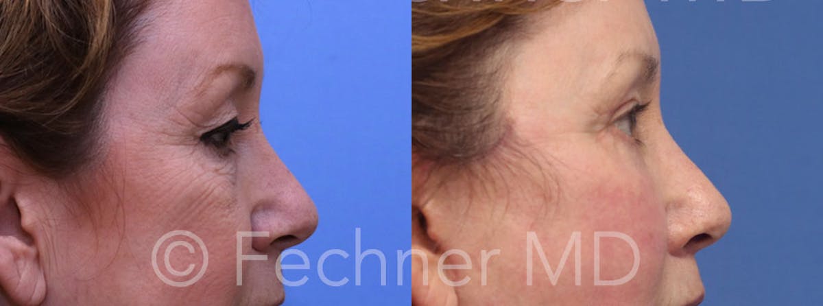 Eyelids Before & After Gallery - Patient 414280 - Image 3