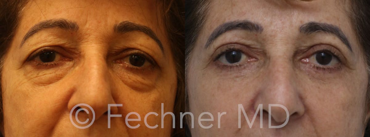 Eyelids Before & After Gallery - Patient 478478 - Image 1