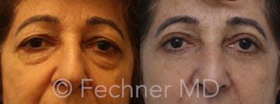 Eyelids Before & After Gallery - Patient 478478 - Image 1