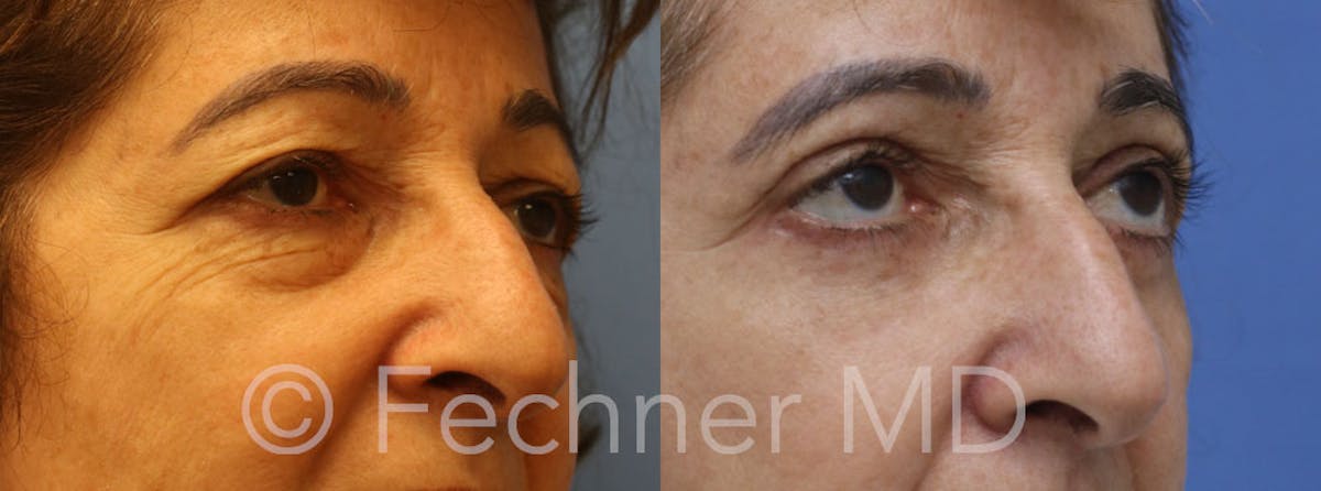 Eyelids Before & After Gallery - Patient 478478 - Image 2