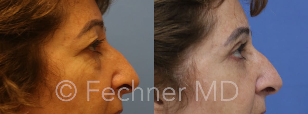 Eyelids Before & After Gallery - Patient 478478 - Image 3