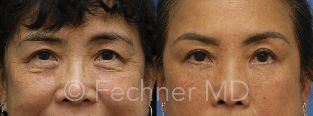 Eyelids Before & After Gallery - Patient 366330 - Image 1