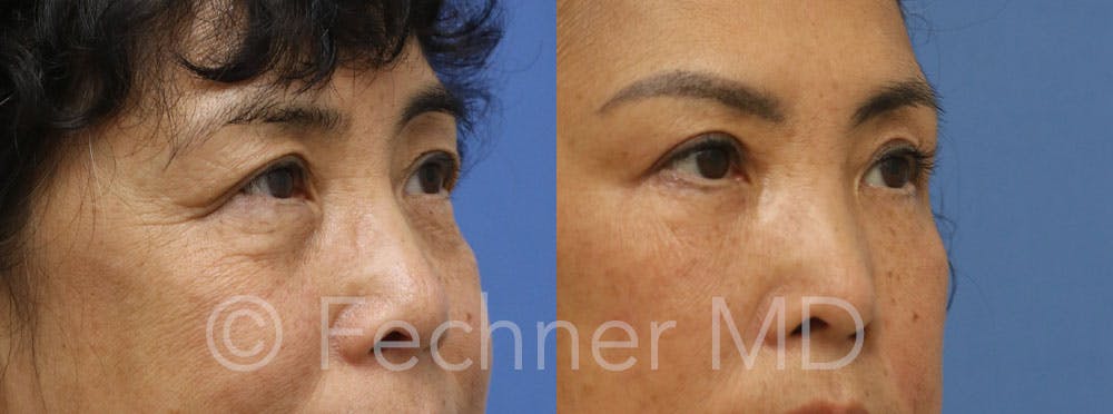 Eyelids Before & After Gallery - Patient 366330 - Image 2