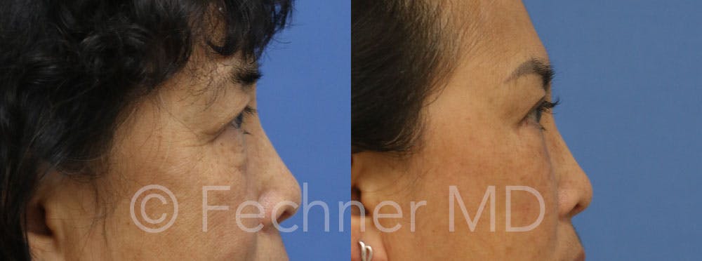 Eyelids Before & After Gallery - Patient 366330 - Image 3